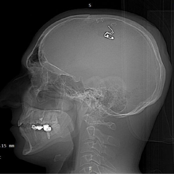 Russia man Drill and tried to place Chip Inside Brain