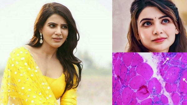 Health Famous Actress Samantha is diagnosed with Myositis and Emergency in Peru Country