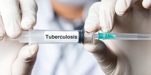 A new vaccine is being prepared against tuberculosis! Intensity in phase III testing 