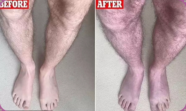  Legs turned blue for Long Covid patient if they stand for just 10 minutes