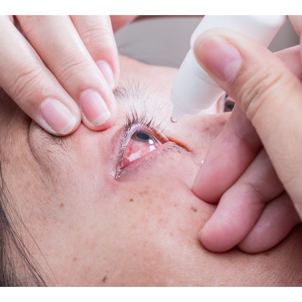 Health: People are getting conjunctivitis, or Madras eye cases all of a sudden in Tamil Nadu 