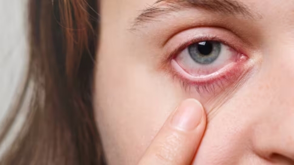 Karnataka sees above 40,000 pink eye cases in just 10 days, what is this? details here 