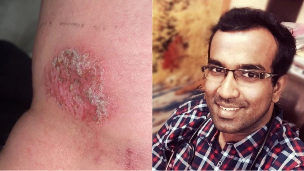  Dr Farook abdulla explains about skin disease in Australia 