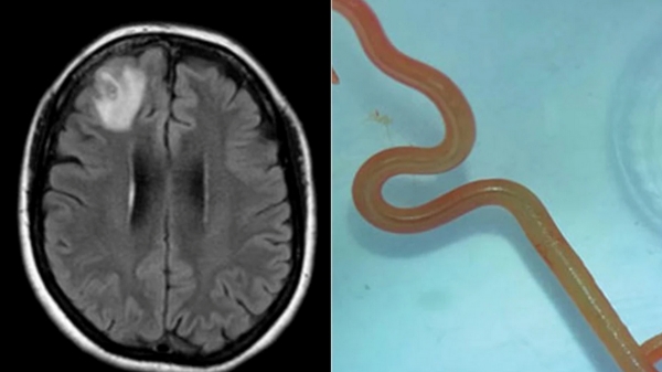 first case in Medical History Australian doctors discovered a live parasitic within the brain of a woman 