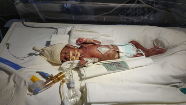 Help save twins born on the 26th month 