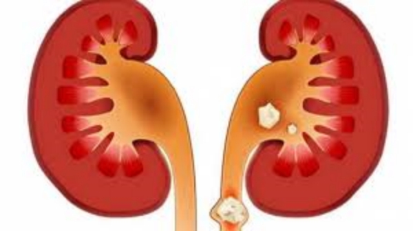 Do you know How to remove Kidney Stones and What foods can be eaten to remove kidney stones