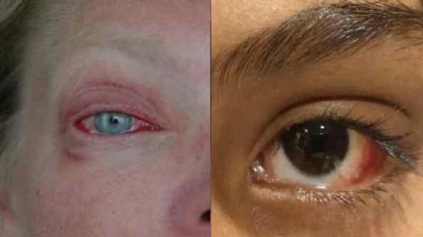 What are the symptoms of Madras Eye inflammation? 