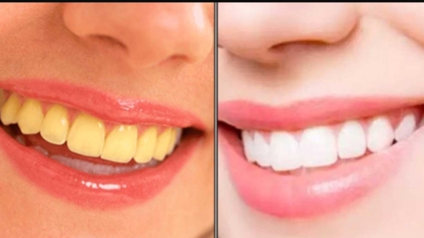 Do you know Health Benefits of Lemon Juice and how to get rid of dark spots on Teeth 