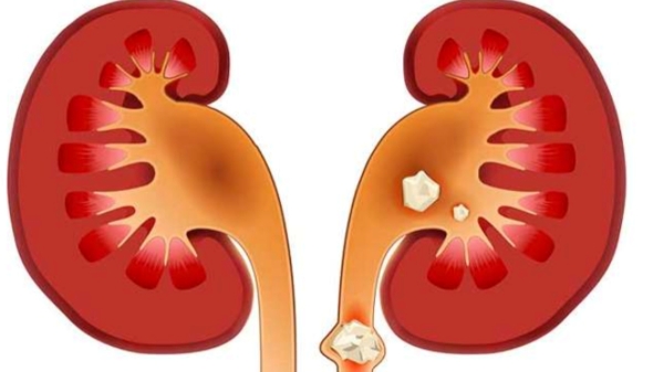 Do you know How to Cure Kidney Infections and What foods can be eaten to avoid kidney Infections Do you know How to Cure Kidney Infections and What foods can be eaten to avoid kidney Infections