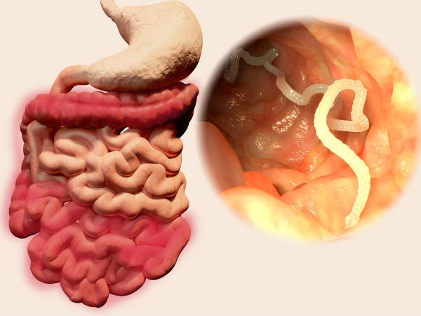 Do you know Excellent Benefits of Garlic and 10 Supertips for Goodbye to Intestinal Parasites 