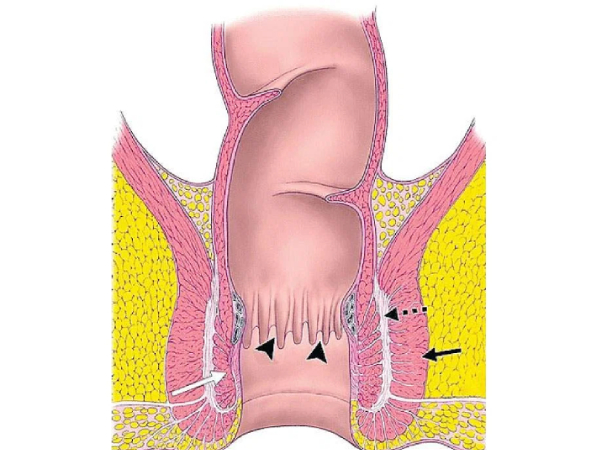 Do you know Potato is the Best for Anal itching and what are the Excellent food for control Anal Itching Do you know Potato is the Best for Anal itching and what are the Excellent food for control Anal Itching