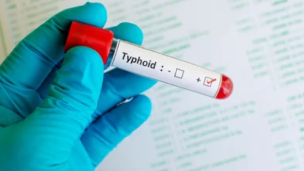 Chennai Perungalathur, Tambaram and Typhoid fever affect increasing in Chennai