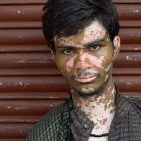 DMK MP MM Abdullah demands that people with white scars Vitiligo should be included in Indian Army DMK MP MM Abdullah demands that people with white scars Vitiligo should be included in Indian Army