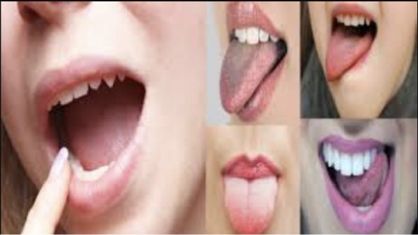 Do you know the Health Benefits of Neem Sticks and Yellow Colour of your tongue will indicate the diseases Do you know the Health Benefits of Neem Sticks and Yellow Colour of your tongue will indicate the diseases
