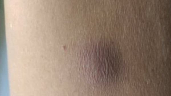  A New bacteria is spreading after Chennai Floods