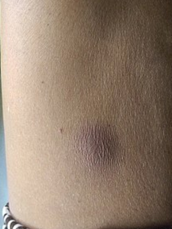 Bacterial disease called melioidosis is threatening the Chennai people 