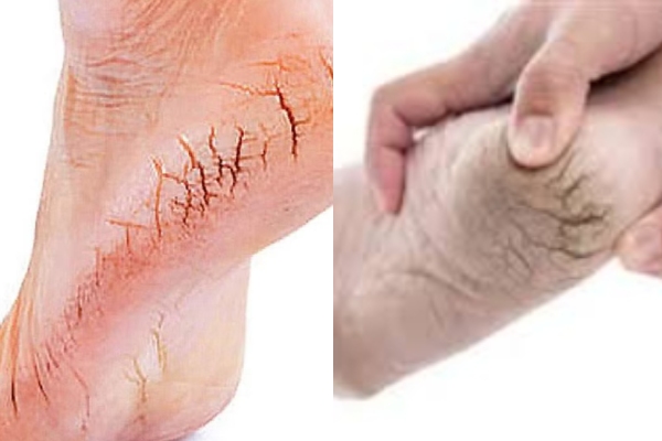 Do you know the Excellent Health Benefits Lemon Juice and what are the Super tips for Cracked heels Do you know the Excellent Health Benefits Lemon Juice and what are the Super tips for Cracked heels