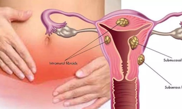 Do you know what are the symptoms of Cervical Cancer and Cervical cancer Vaccination should be free, asks doctors