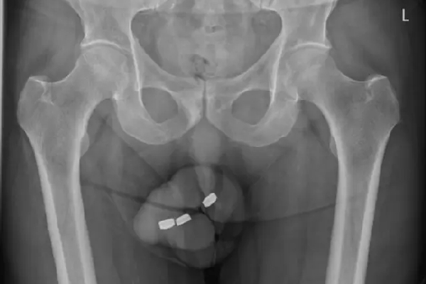 Doctors Remove Batteries From private part of 73 year old man in Australia 