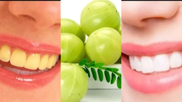 Amazing Medicinal Uses of Indian Gooseberry and what are the Super tips to Strengthen Loose Teeth