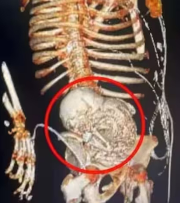 81 year old woman in Brazil dies after undergoing surgery to remove a 56 year old foetus from her abdomen