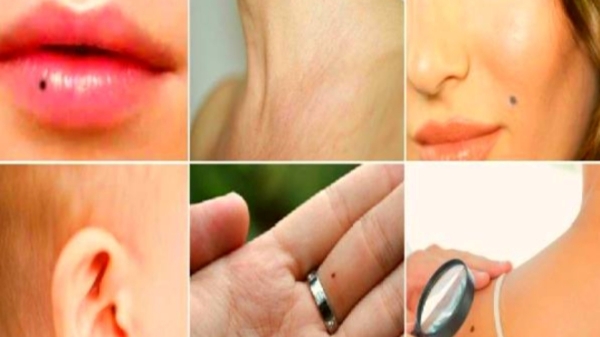 What are the benefit of having Mole on forehead Lips and what did samutrikka lakshana shastra say about the Mole What are the benefit of having Mole on forehead Lips and what did samutrikka lakshana shastra say about the Mole