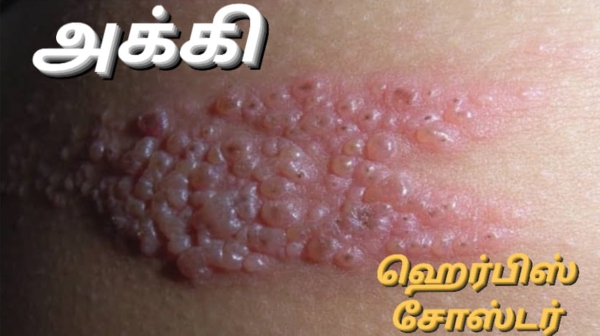 Dr farook Abdulla explains about Akki Shingles