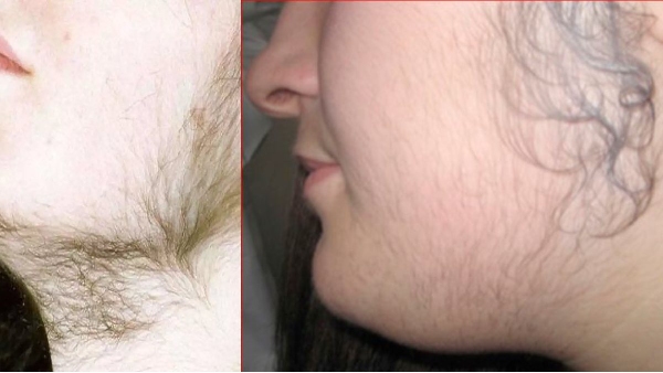 Super tips to remove unwanted hair on the face and Do you know How to remove facial hair in Healthy Way