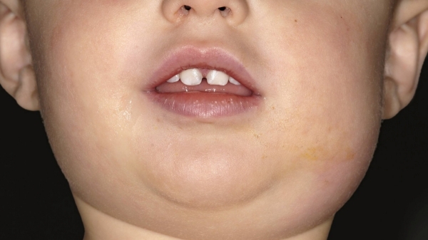 Dr Farook Abdulla says about Mumps virus disease