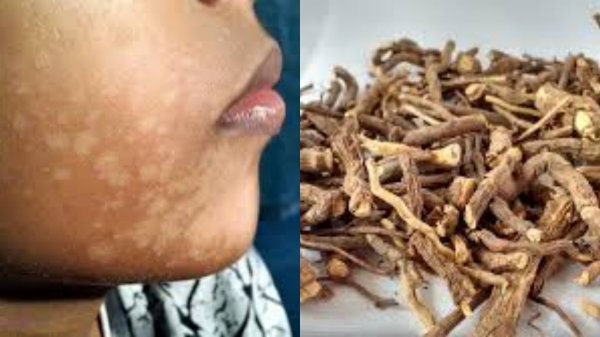 Amazing Health Benefits of Nannari Root to cure Themal and What are the Excellent Tips to remove Skin White Patches Amazing Health Benefits of Nannari Root to cure Themal and What are the Excellent Tips to remove Skin White Patches