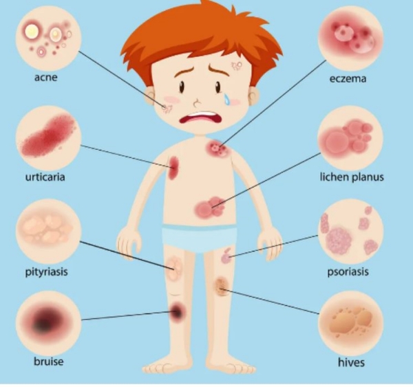 What is the remedy for summer skin diseases