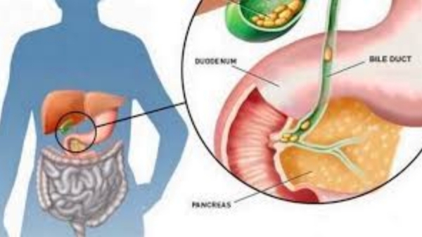 Super 6 Tips to avoid Gallbladder Stones and What are the Fantastic foods to eat to prevent form Gallstones Super 6 Tips to avoid Gallbladder Stones and What are the Fantastic foods to eat to prevent form Gallstones