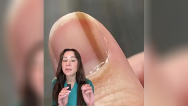 This sign might indicate skin cancer US Dermatologist gives new warning