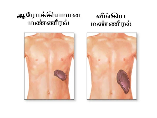 Do you know Apple Juice is the Best Drink for Shrink enlarged Spleen and Are these the symptoms of Splenomegaly Do you know Apple Juice is the Best Drink for Shrink enlarged Spleen and Are these the symptoms of Splenomegaly