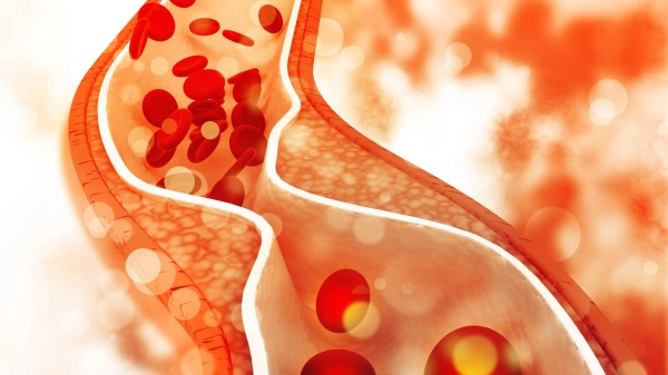 Health cholesterol Cinnamon