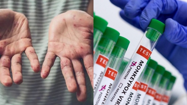 mpox Virus Monkey Pox Virus Kurangu ammai