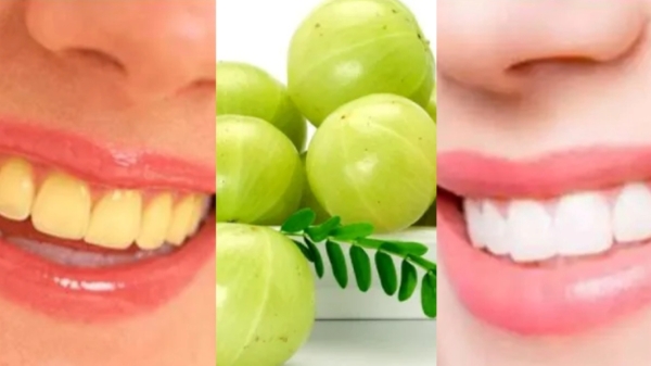 Teeth Tooth Home remedies