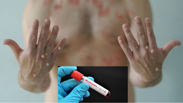 monkeypox delhi monkeypox virus