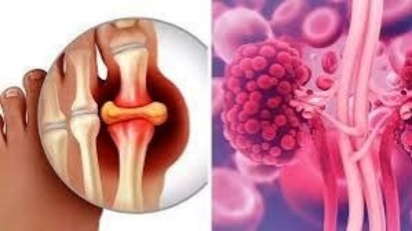 high uric acid uric acid level foods high uric acid uric acid level foods