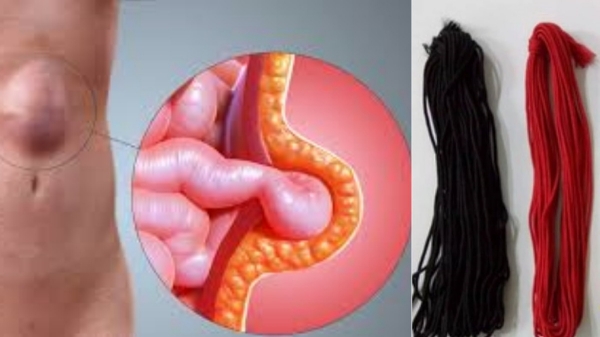 hernia pain waist card health