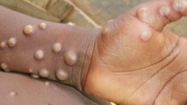 monkey pox virus trichy