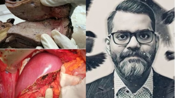 health alcoholic liver