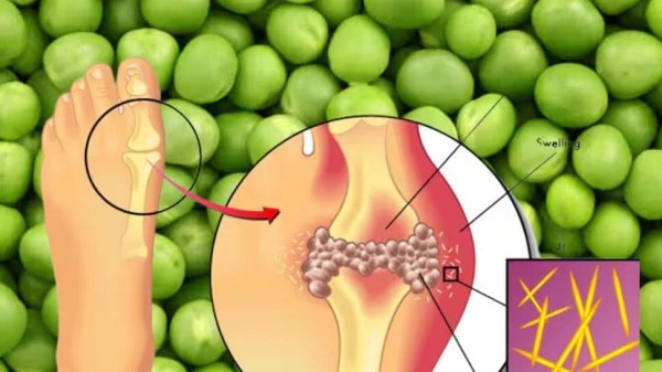 green peas high uric acid green peas high uric acid