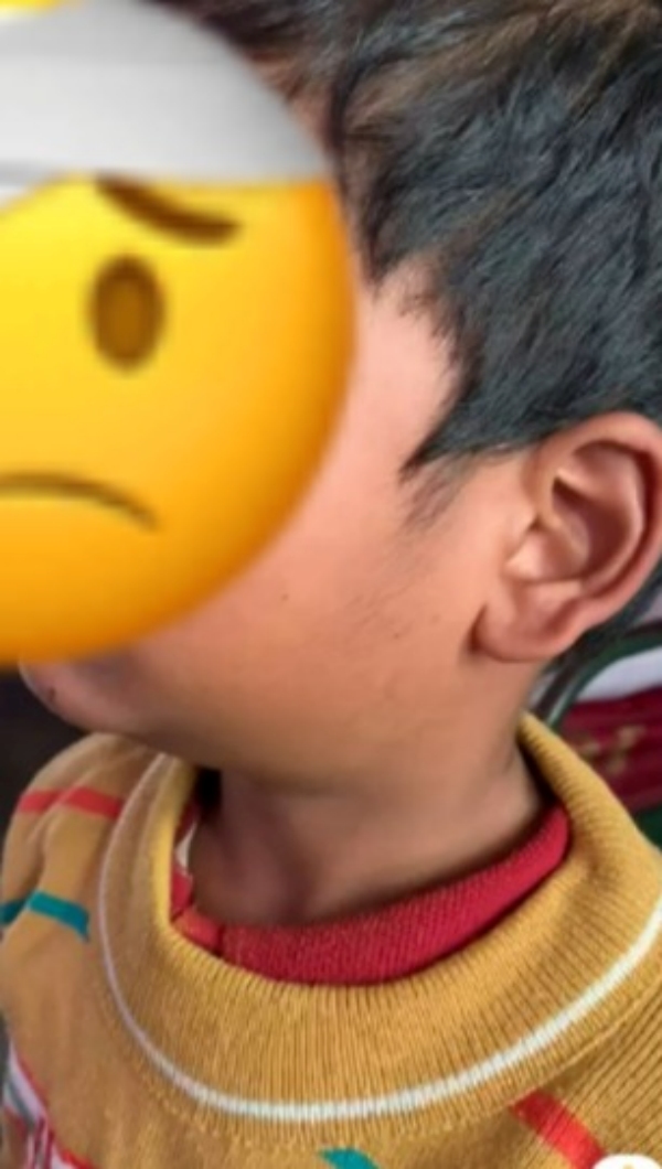 Mumps Dindigul health Mumps Dindigul health