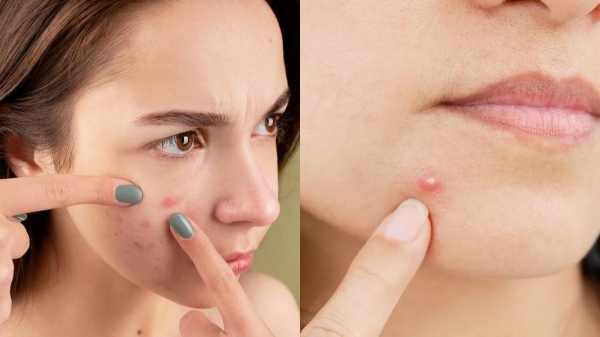 pimple health pimple health