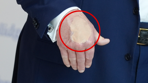 What really happen to Trump as his swollen legs and bruised hands pictures created speculations