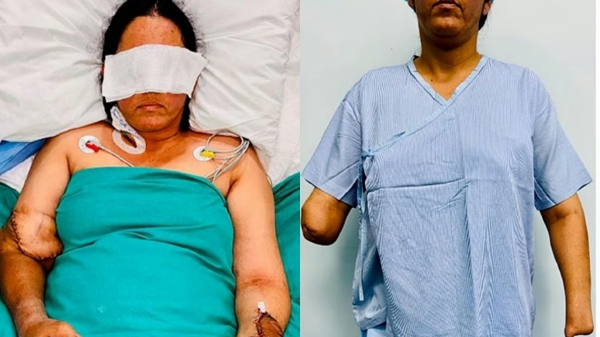 Delhi Hospital miracle Hand transplant surgery Sir Ganga Ram Hospital news Brain dead organ donation Medical milestone India Double hand transplant Dr Mahesh Mangal Successful surgery stories Spine-chilling operation Delhi
