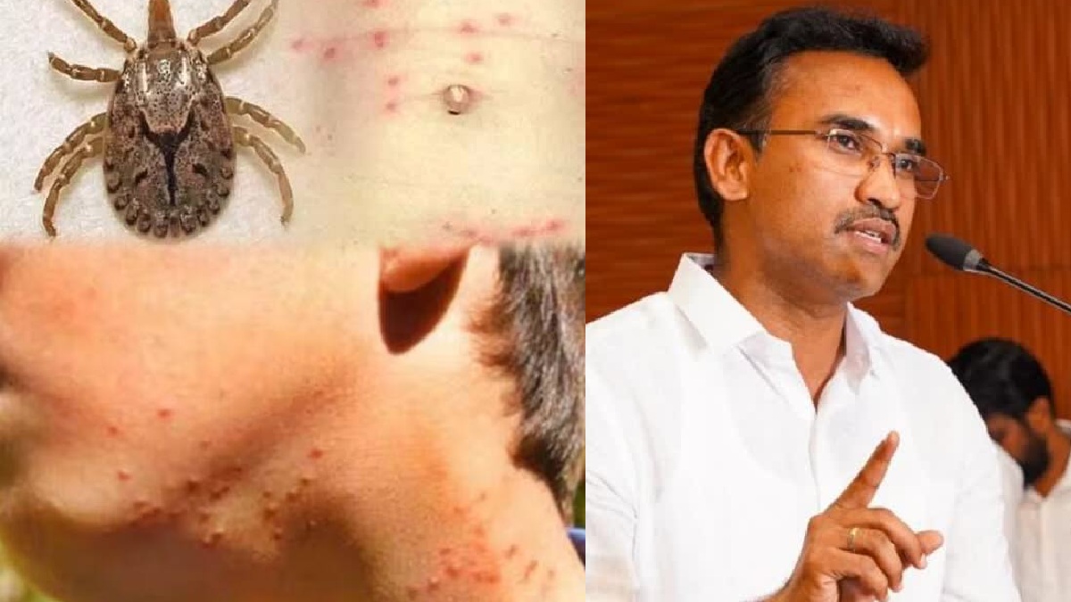தமிழ்நாட்டில் உண்ணி காய்ச்சல் பாதிப்பு அதிகரிப்பு: 4,619 பேர் பாதிப்பு