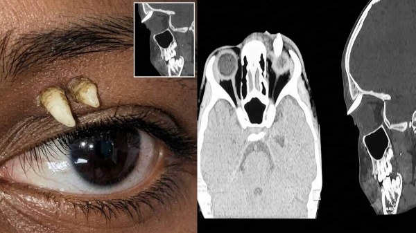 Tooth Inside Eye Socket