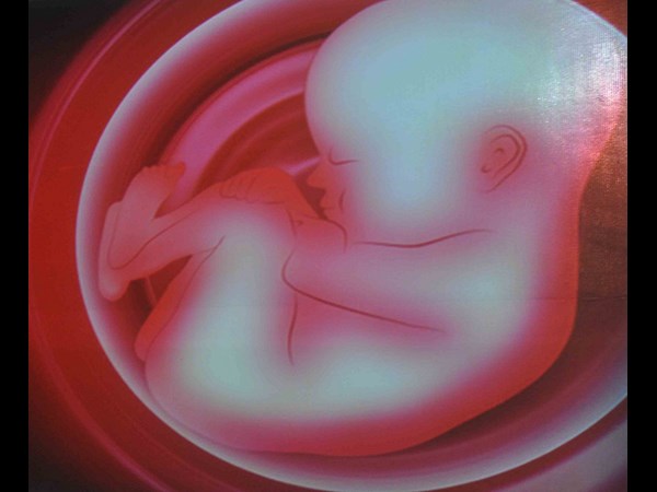 గర్భస్థ శిశువుకు సర్జరీ